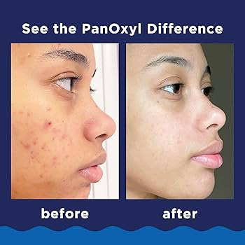 Panoxyl 10% Acne Foaming Wash